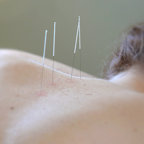 Acupuncture Needles